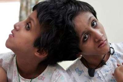 هندي يطلب "القتل الرحيم" لابنتيه الملتصقتين عند المخ